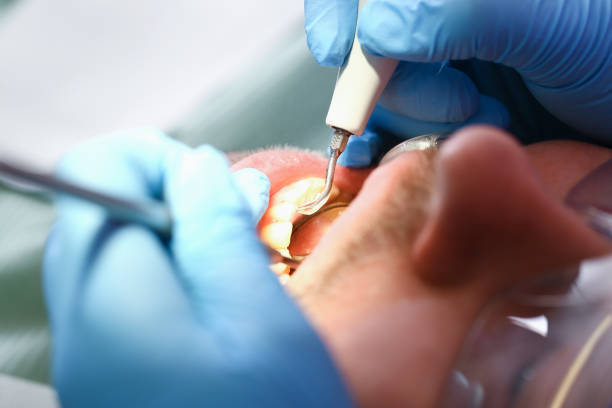 Best Emergency Wisdom Teeth Removal in Danville, IA
